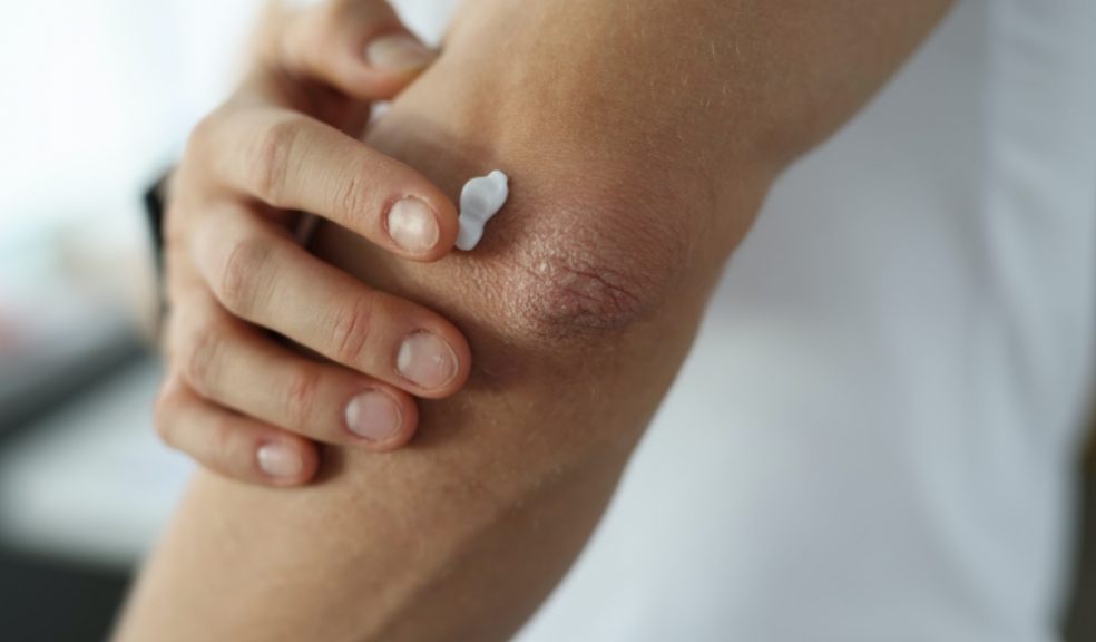 Find out how you can relieve the symptoms of eczema naturally eczema